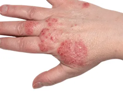 Eczema