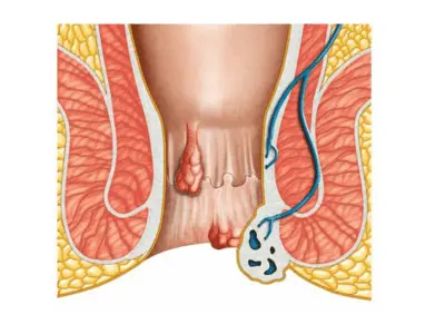 Fistula