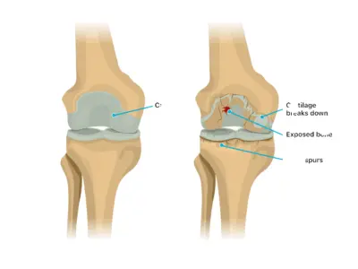 Osteoarthritis