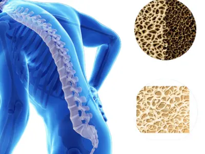 Osteoporosis