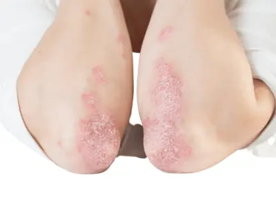 Psoriasis