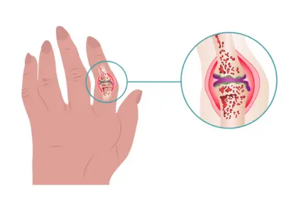 Rheumatoid Arthritis