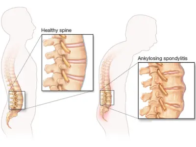 Spondylitis