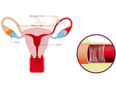 Tubal Blockage