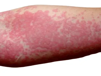 Urticaria