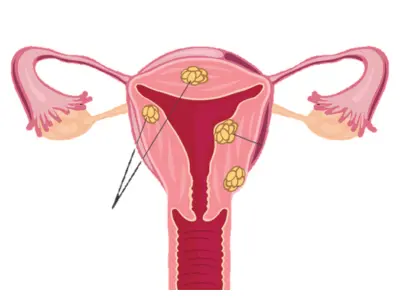 Uterine Fibroid